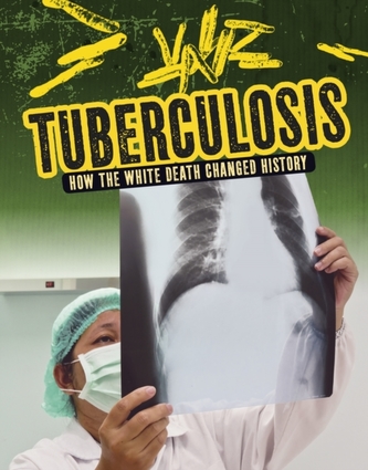 Tuberculosis